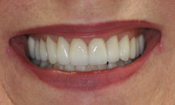 teeth whitening treatments by Dr. Angela Courtney
