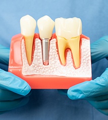 Dentist with gloved hands holding model of dental implant