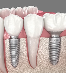 Illustration of two dental implants in the lower jaw
