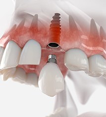 Dental crown being attached to a dental implant in the upper jaw