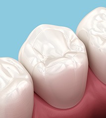 Illustration of a tooth-colored filling