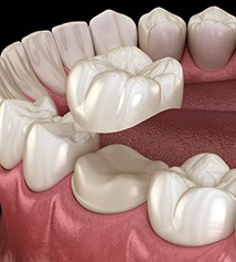 Illustration of a dental crown
