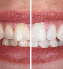 Closeup of patient's teeth before and after teeth whitening
