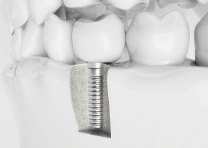 Model of dental implant