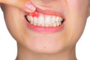 woman with gums exposed pink spot