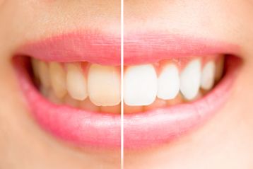 A smile before and after whitening