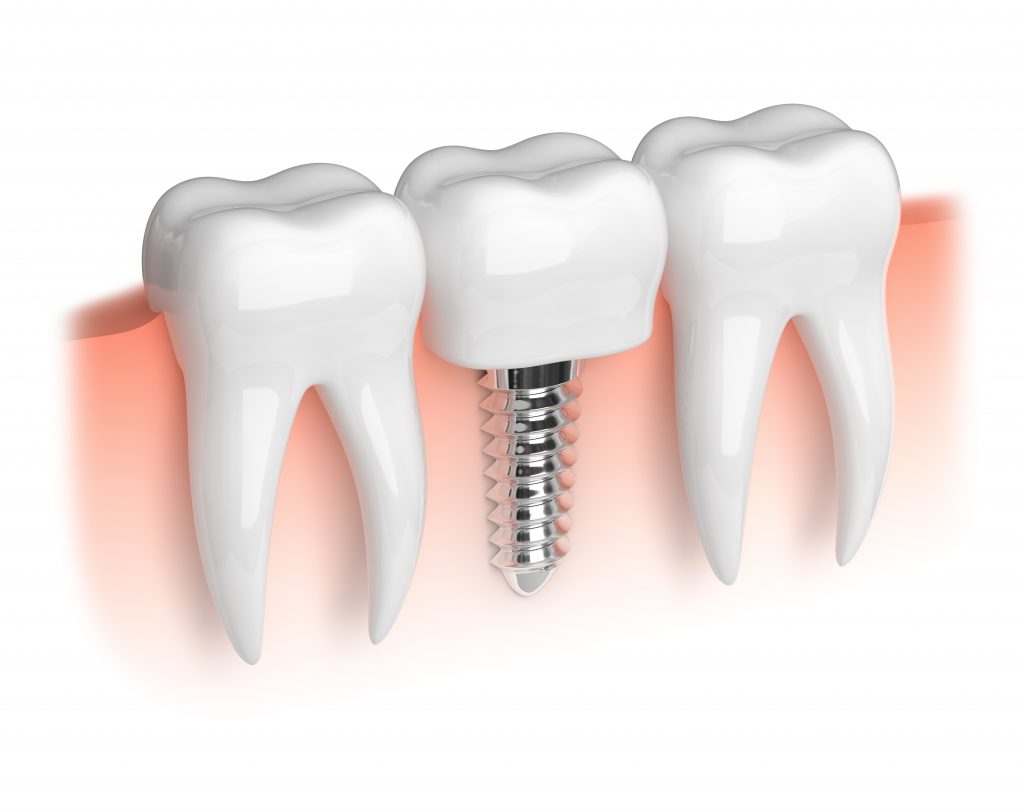 Dental Implant With Normal Teeth