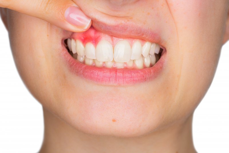 young woman red spot on gums