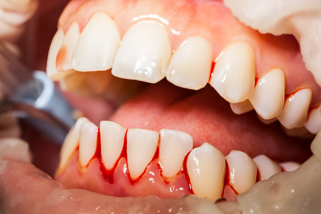 Wondering Why Your Gums Bleed You Floss Your Teeth?