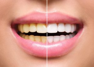 Discolored smile before and after visiting Upper Arlington dentist