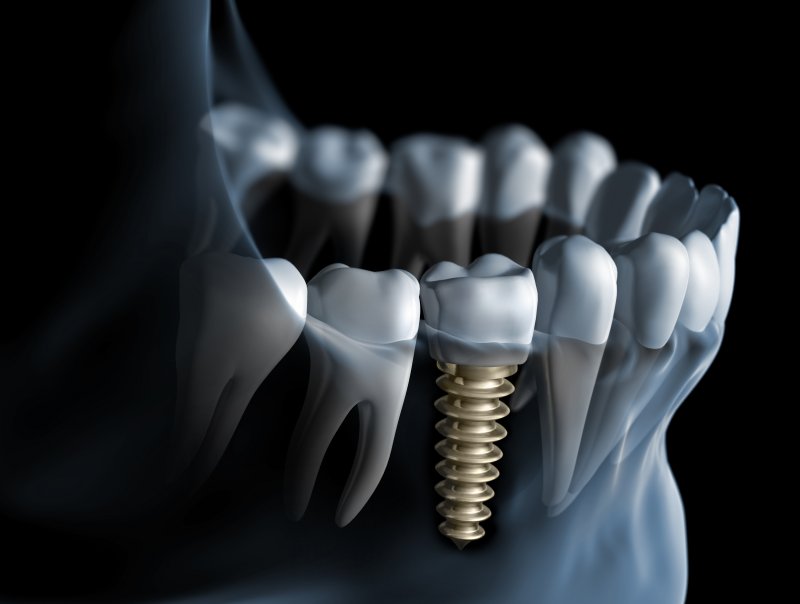 Dental implants