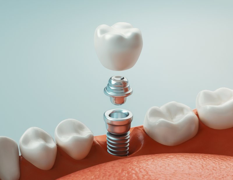 3D rendering of dental implant