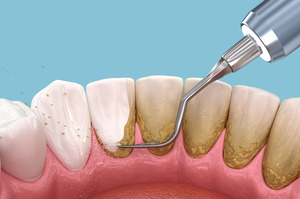 Picture of a plaque-covered smile
